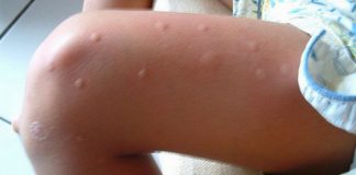 Se os mosquitos sempre vão direto para você, aqui está o que você precisa saber