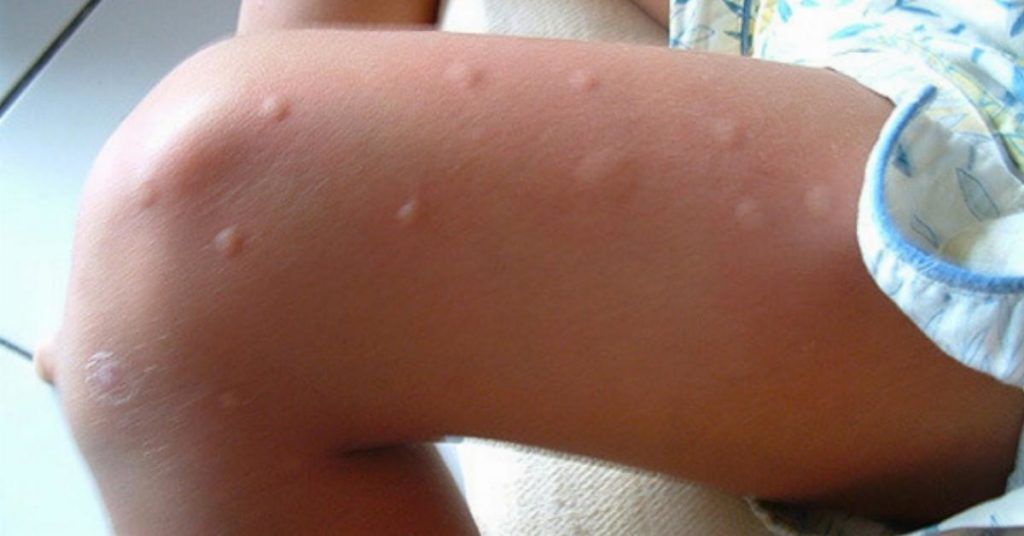 Se os mosquitos sempre vão direto para você, aqui está o que você precisa saber