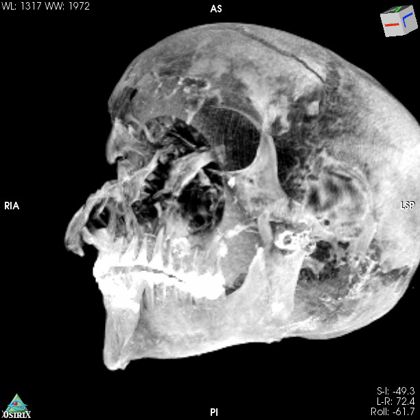 pensarcontemporaneo.com - Tomografias computadorizadas de múmias egípcias revelam novos detalhes sobre a morte de um importante faraó
