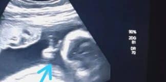 Bebê faz “V” de vitória em ultrassom e pai com câncer vê sinal divino