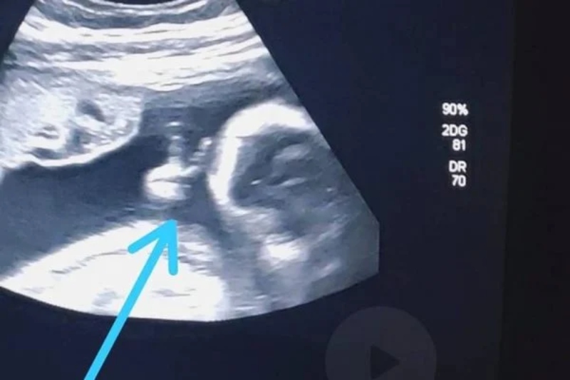 Bebê faz “V” de vitória em ultrassom e pai com câncer vê sinal divino