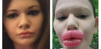 Mulher com ‘maiores lábios do mundo’ agora quer aumentar outra parte do corpo – saiba qual é