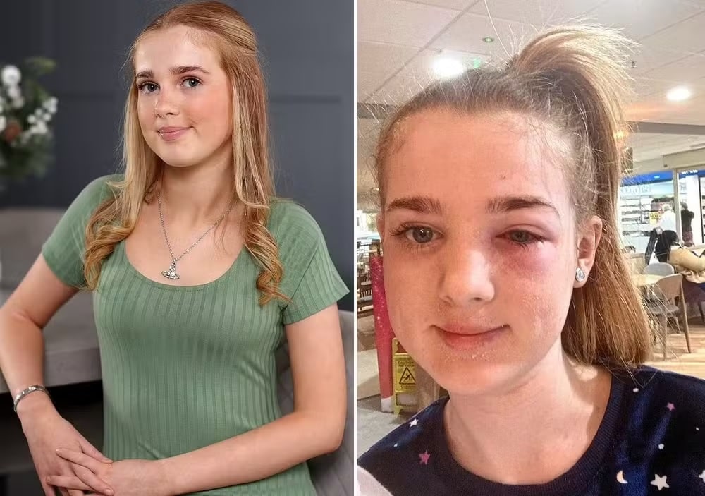 pensarcontemporaneo.com - Menina de 13 anos quase fica cega após levar 'dica de beleza' no TikTok à sério demais