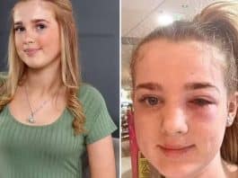 Menina de 13 anos quase fica cega após levar 'dica de beleza' no TikTok à sério demais