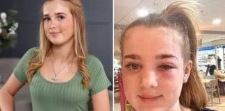 Menina de 13 anos quase fica cega após levar ‘dica de beleza’ no TikTok à sério demais