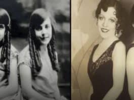 A BIZARRA HISTÓRIA da gêmea siamesa que foi obrigada a viver com a irmã morta LIGADA À ELA