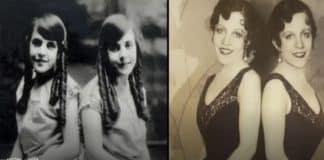 A BIZARRA HISTÓRIA da gêmea siamesa que foi obrigada a viver com a irmã morta LIGADA À ELA