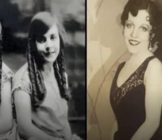 A BIZARRA HISTÓRIA da gêmea siamesa que foi obrigada a viver com a irmã morta LIGADA À ELA