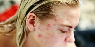 Manchas de acne: alternativas para diminuir as hiperpigmentação na pele
