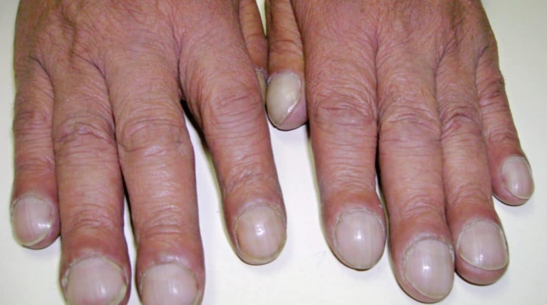 Essa grande mudança nos dedos pode ser sinal de doença grave Esse formato nas pontas dos dedos pode ser sinal de algo sério… e muita gente ignora