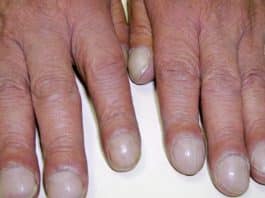 Esse formato nas pontas dos dedos pode ser sinal de algo sério... e muita gente ignora