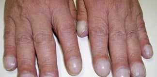 Esse formato nas pontas dos dedos pode ser sinal de algo sério… e muita gente ignora