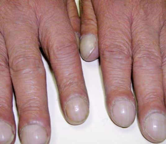 Esse formato nas pontas dos dedos pode ser sinal de algo sério... e muita gente ignora