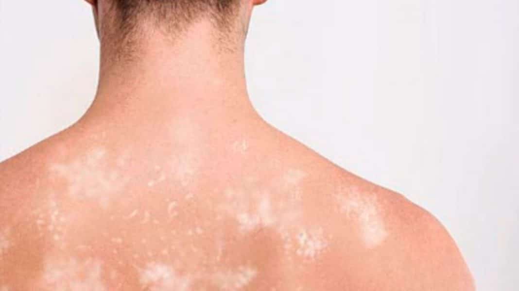 janeiro roxo contra hanseníase 2026 Janeiro Roxo: Brasil é 2º país mais afetado no mundo pela hanseníase – veja como se prevenir