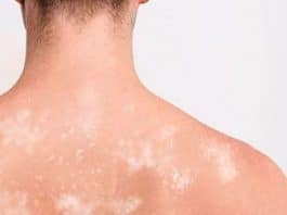 janeiro roxo contra hanseníase 2026