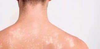 Janeiro Roxo: Brasil é 2º país mais afetado no mundo pela hanseníase – veja como se prevenir janeiro roxo contra hanseníase 2026