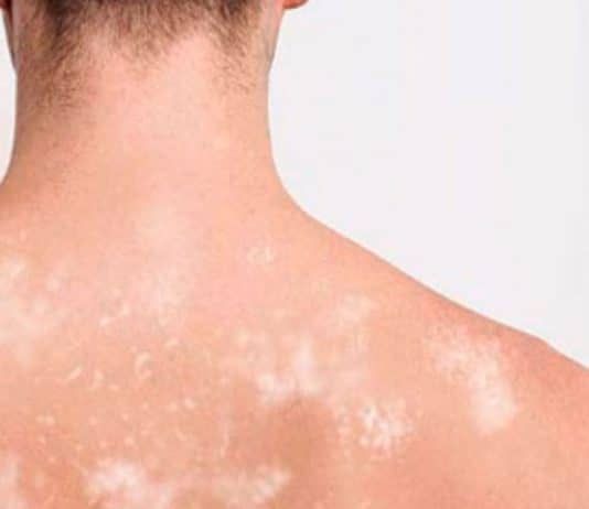 janeiro roxo contra hanseníase 2026