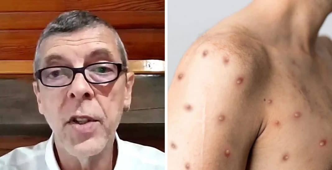 mpox medico brasileiro explica Mpox pode virar epidemia ou surto no Brasil? Médico explica o que realmente preocupa no momento