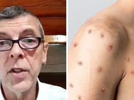 mpox medico brasileiro explica