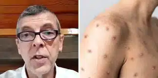 Mpox pode virar epidemia ou surto no Brasil? Médico explica o que realmente preocupa no momento mpox medico brasileiro explica