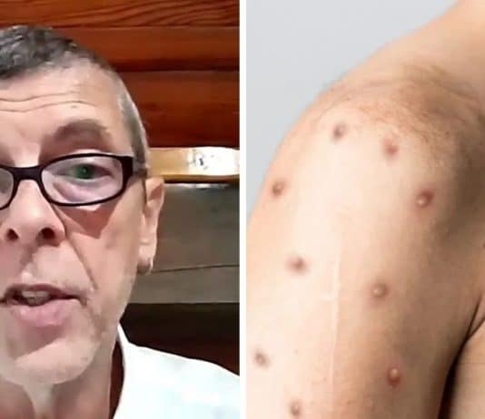 mpox medico brasileiro explica