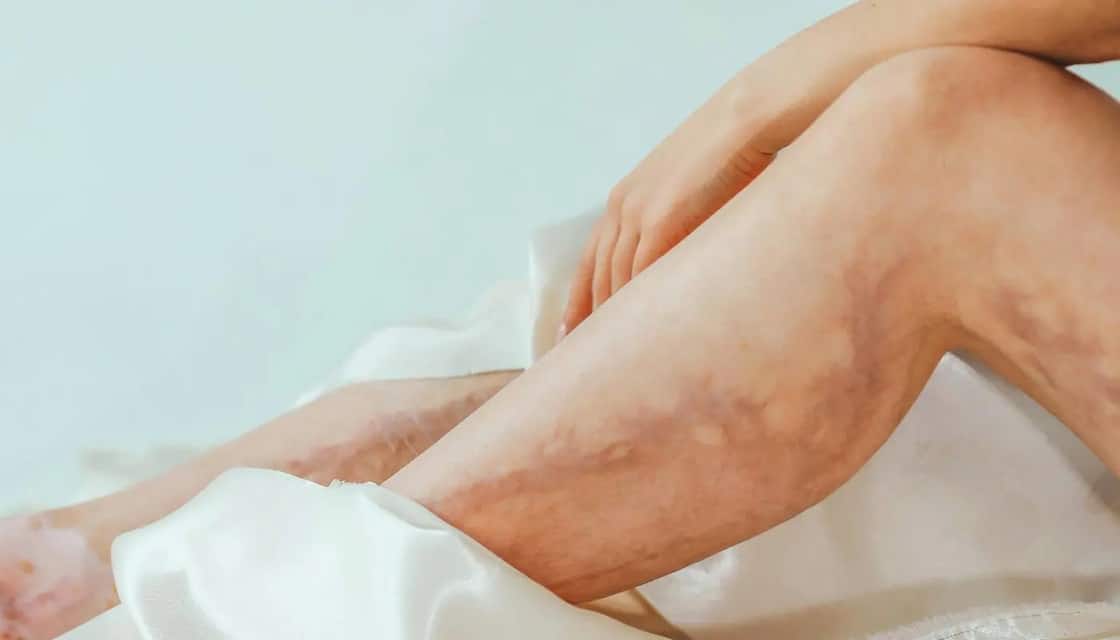 Veias muito visíveis? Entenda o que o teu corpo pode estar tentando lhe dizer pensarcontemporaneo.com - Veias muito visíveis? Entenda o que o teu corpo pode estar tentando lhe dizer