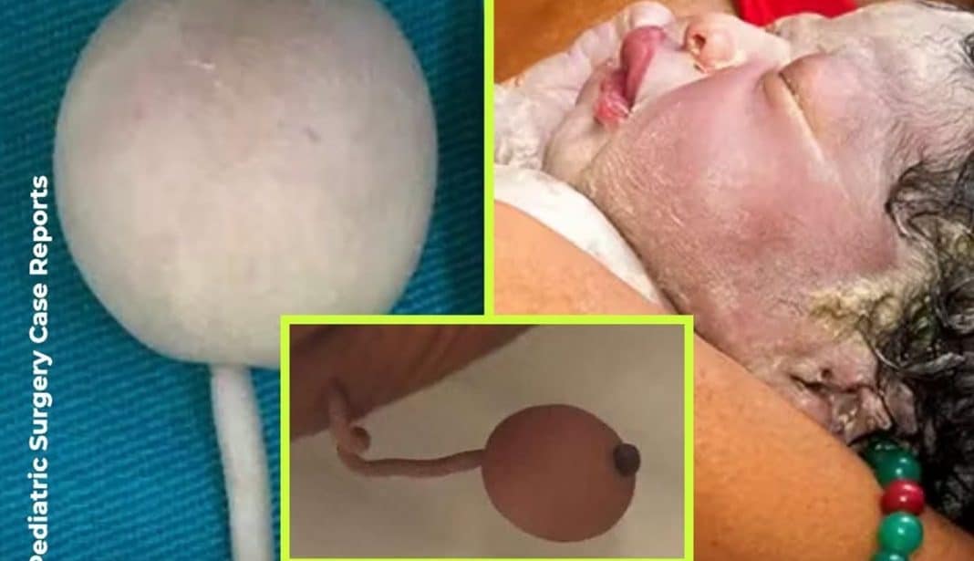 O bebê brasileiro que nasceu com uma cauda de 12 centímetros terminando em uma esfera e deixou os médicos perplexos