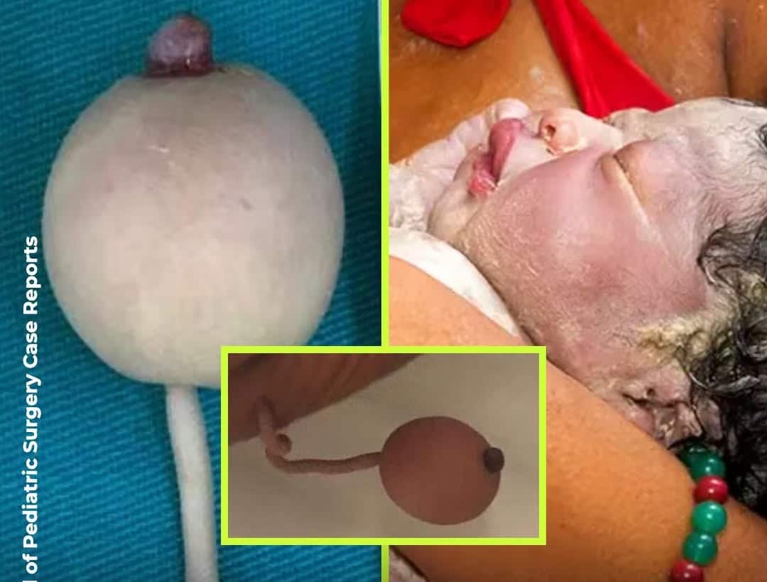 pensarcontemporaneo.com - O beb&ecirc; brasileiro que nasceu com uma cauda de 12 cent&iacute;metros terminando em uma esfera e deixou os m&eacute;dicos perplexos