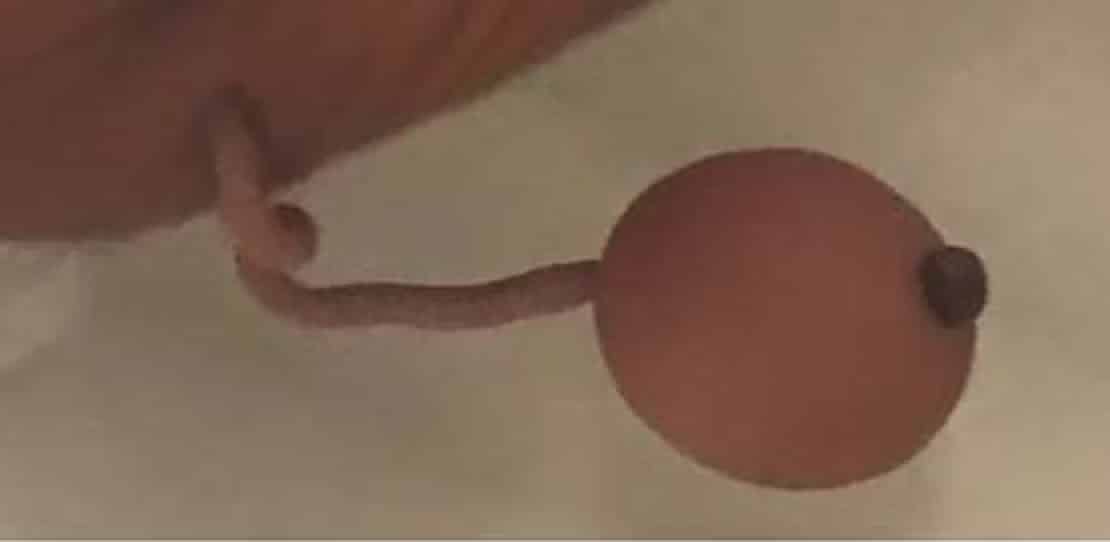pensarcontemporaneo.com - O beb&ecirc; brasileiro que nasceu com uma cauda de 12 cent&iacute;metros terminando em uma esfera e deixou os m&eacute;dicos perplexos