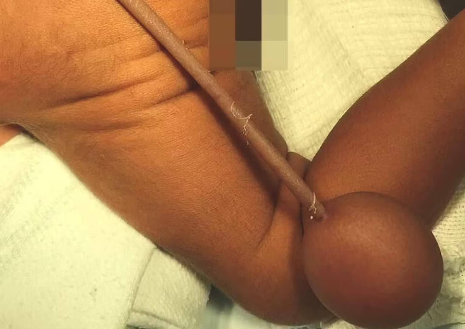 pensarcontemporaneo.com - O beb&ecirc; brasileiro que nasceu com uma cauda de 12 cent&iacute;metros terminando em uma esfera e deixou os m&eacute;dicos perplexos