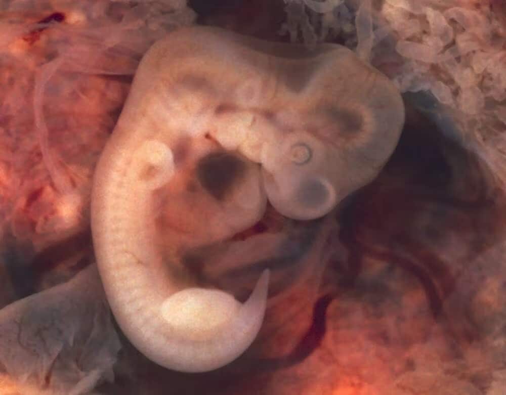 pensarcontemporaneo.com - O beb&ecirc; brasileiro que nasceu com uma cauda de 12 cent&iacute;metros terminando em uma esfera e deixou os m&eacute;dicos perplexos