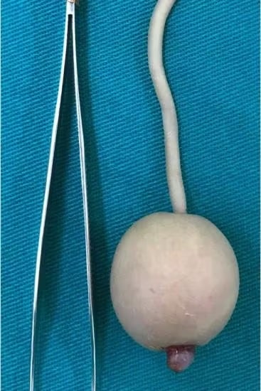pensarcontemporaneo.com - O beb&ecirc; brasileiro que nasceu com uma cauda de 12 cent&iacute;metros terminando em uma esfera e deixou os m&eacute;dicos perplexos