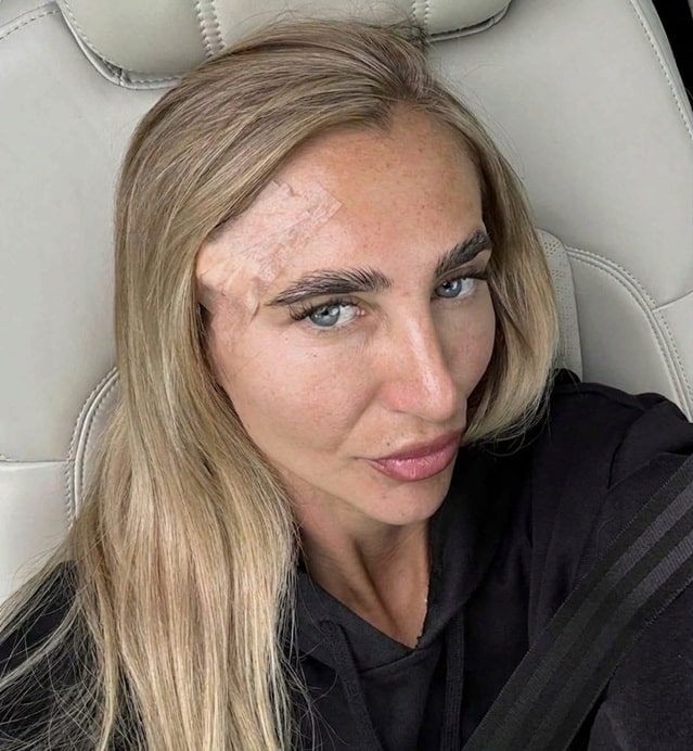 pensarcontemporaneo.com - Ela buscava o bronzeado perfeito, mas aos 28 anos recebeu um diagn&oacute;stico assustador